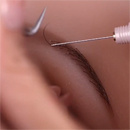頭部機能追加:眉毛の植毛
