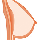 乳房タイプ:固体タイプ
