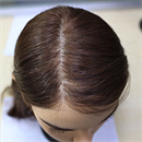 髪の毛の植毛:あり